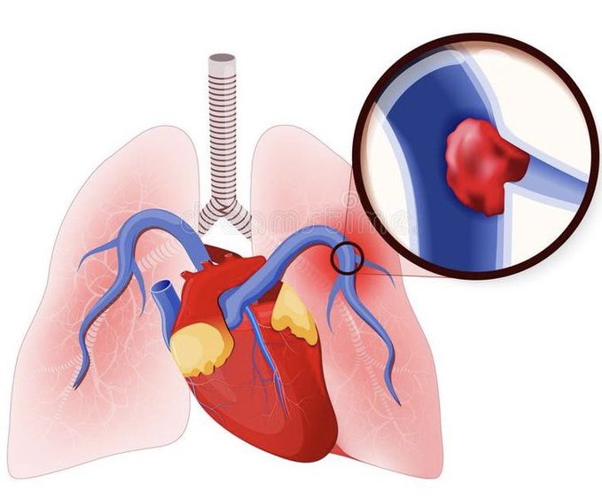 الجلطة الدموية في الرئتين